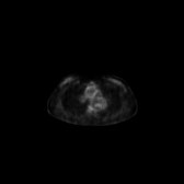 B-cell lymphoma of the mesentery (Radiopaedia 65743-74868 18F-FDG PET-CT 210).jpg
