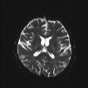 Balo concentric sclerosis (Radiopaedia 50458-55940 Axial DWI 10).jpg