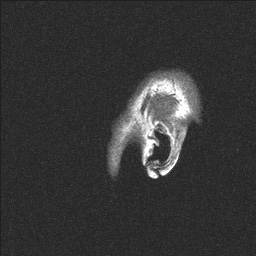 Balo concentric sclerosis (Radiopaedia 50458-55940 Sagittal T1 152).jpg