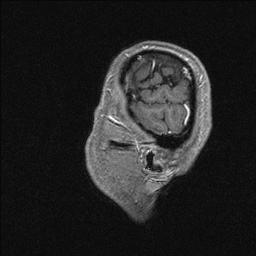 Balo concentric sclerosis (Radiopaedia 50458-55940 Sagittal T1 C+ 18).jpg