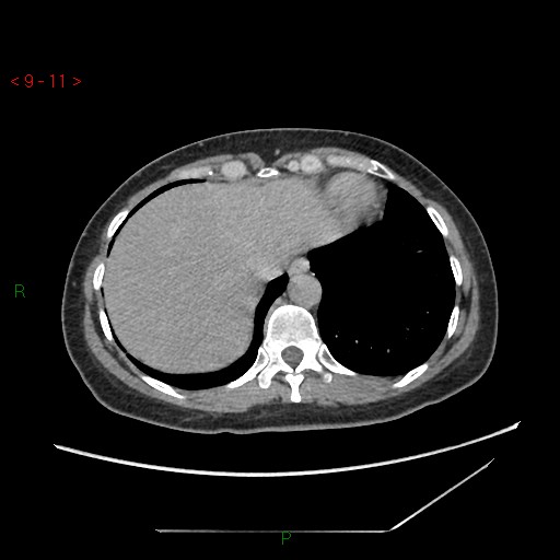 File:Bartholin gland cyst (Radiopaedia 54904-61181 Axial C+ delayed 3).jpg