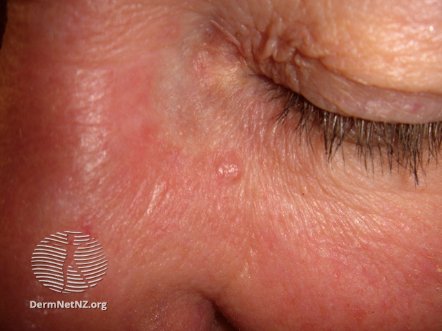 Basal cell carcinoma affecting the face (DermNet NZ lesions-bcc-face-0823).jpg