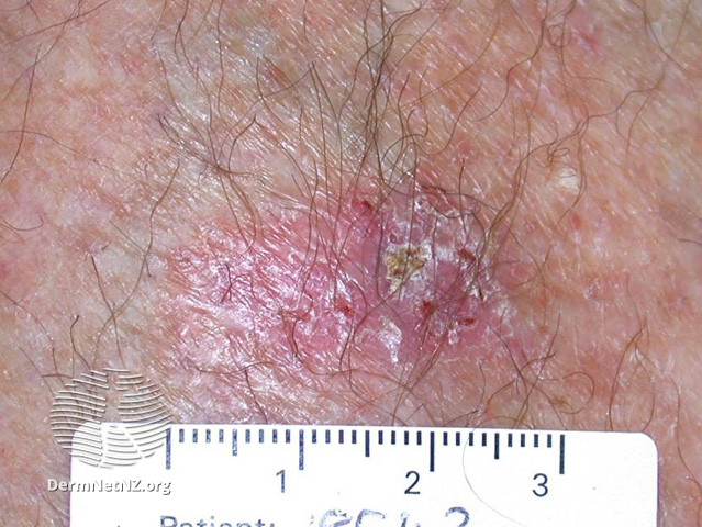 File:Basal cell carcinoma affecting the face (DermNet NZ lesions-bcc-face-0985).jpg