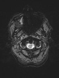 Base of skull chondrosarcoma (Radiopaedia 30410-31070 Axial SWI 2).jpg
