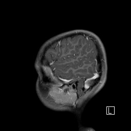 Base of skull rhabdomyosarcoma (Radiopaedia 32196-33142 J 12).jpg