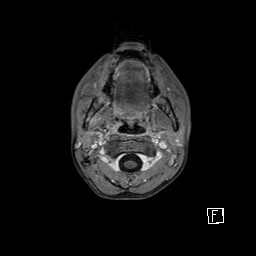 Base of skull rhabdomyosarcoma (Radiopaedia 32196-33142 T1 C+ fat sat 13).jpg