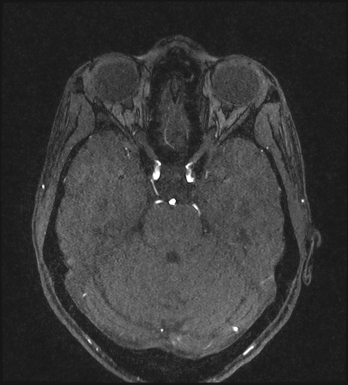 Basilar artery perforator aneurysm (Radiopaedia 82455-97733 Axial MRA 89).jpg