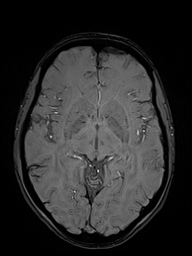 Basilar artery perforator aneurysm (Radiopaedia 82455-97733 Axial SWI 27).jpg