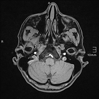 Basilar artery perforator aneurysm (Radiopaedia 82455-99523 F 13).jpg