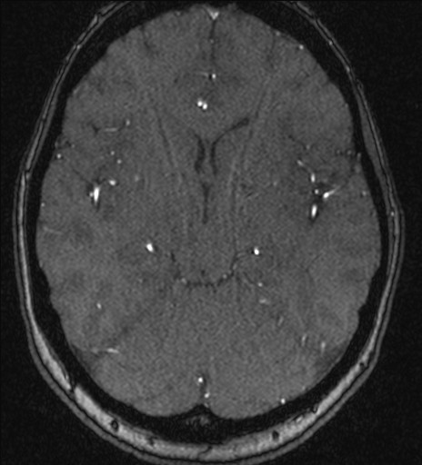 Basilar tip aneurysm (Radiopaedia 26504-26632 MRA 107).jpg