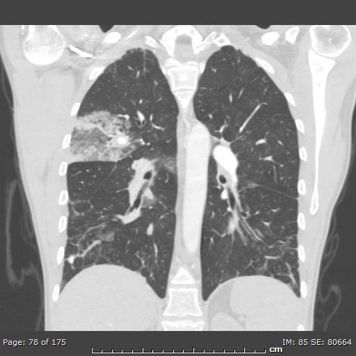 Behçet disease (Radiopaedia 44247-47889 Coronal lung window 22).jpg