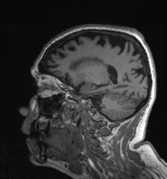 Behavioral variant frontotemporal dementia and late onset schizophrenia (Radiopaedia 52197-58083 Sagittal T1 29).png