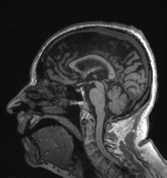 Behavioral variant frontotemporal dementia and late onset schizophrenia (Radiopaedia 52197-58083 Sagittal T1 50).png