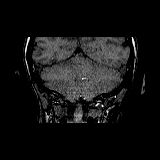 File:Berry aneurysm of the terminal internal carotid artery (Radiopaedia 88286-104918 Coronal TOF 91).jpg