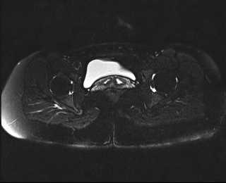 File:Bicornuate bicollis uterus (Radiopaedia 61626-69616 Axial PD fat sat 26).jpg