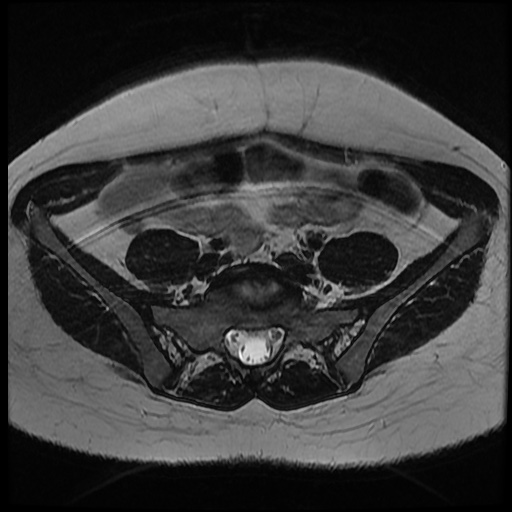 File:Bicornuate uterus (Radiopaedia 51676-57472 Axial T2 30).jpg