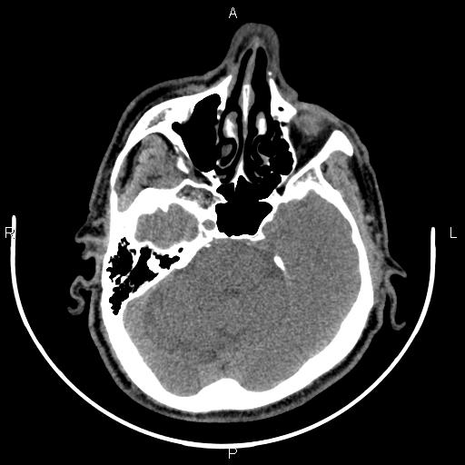 Bilateral Warthin tumors (Radiopaedia 84034-99263 Axial non-contrast 1).jpg