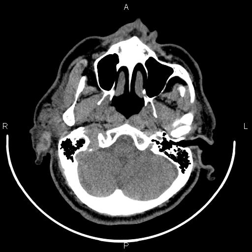 Bilateral Warthin tumors (Radiopaedia 84034-99263 Axial non-contrast 9).jpg