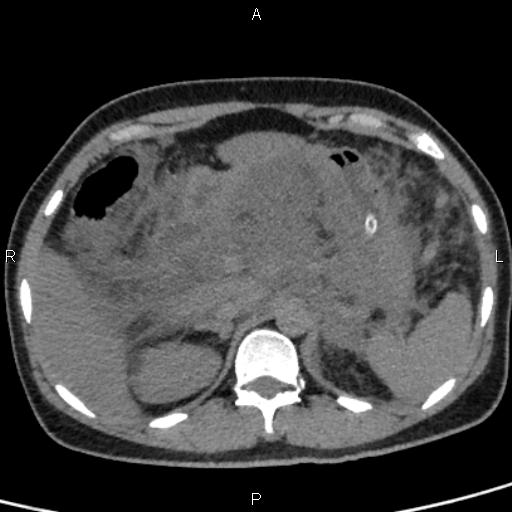Bilateral adrenal gland hyperenhancement in pancreatitis (Radiopaedia 86642-102753 Axial non-contrast 31).jpg