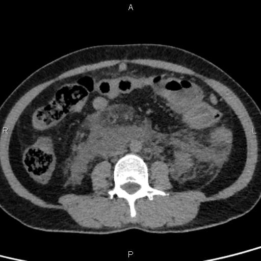 Bilateral adrenal gland hyperenhancement in pancreatitis (Radiopaedia 86642-102753 Axial non-contrast 63).jpg