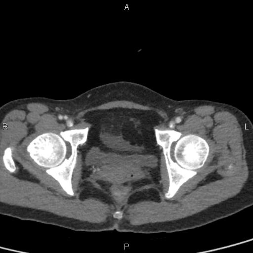 Bilateral adrenal gland hyperenhancement in pancreatitis (Radiopaedia 86642-102753 E 106).jpg