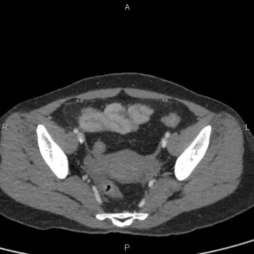 Bilateral adrenal gland hyperenhancement in pancreatitis (Radiopaedia 86642-102753 E 95).jpg
