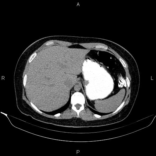 Bilateral adrenal myelolipoma (Radiopaedia 63058-71535 Axial non-contrast 30).jpg