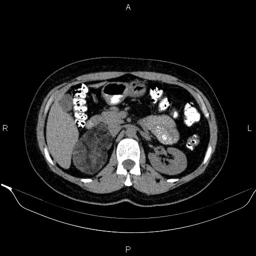 Bilateral adrenal myelolipoma (Radiopaedia 63058-71535 Axial non-contrast 61).jpg