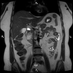File:Bilateral adrenal myelolipoma (Radiopaedia 63058-71537 Coronal T2 18).jpg