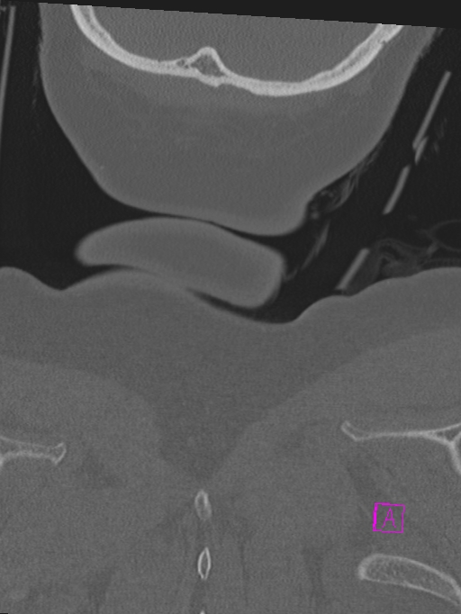 Bilateral atlanto-occipital assimilation (Radiopaedia 28350-28603 Coronal bone window 58).jpg