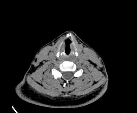 Bilateral carotid body tumors (Radiopaedia 61841-69870 Axial non-contrast 73).jpg