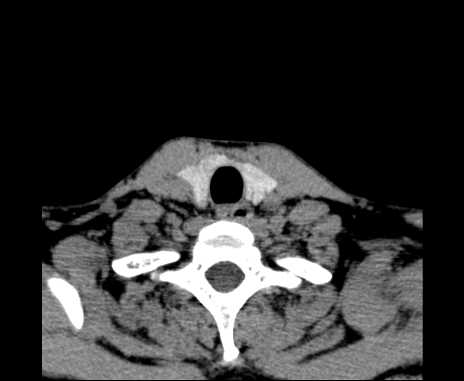 Bilateral carotid body tumors (Radiopaedia 61841-69870 Axial non-contrast 96).jpg