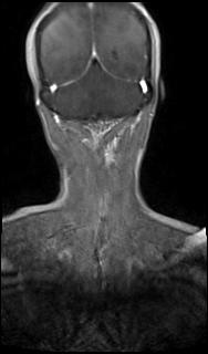 File:Bilateral carotid body tumors and right glomus jugulare tumor (Radiopaedia 20024-20060 MRA 66).jpg