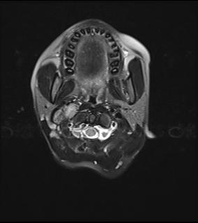 File:Bilateral carotid body tumors and right jugular paraganglioma (Radiopaedia 20024-20060 Axial 36).jpg