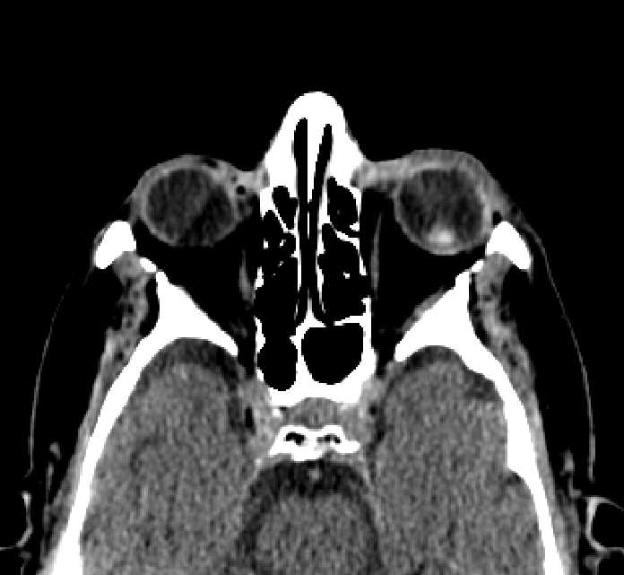 Bilateral ectopia lentis (Radiopaedia 89889-107013 Axial non-contrast 50).jpg