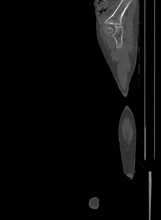 Bilateral fibular hemimelia type II (Radiopaedia 69581-79491 Sagittal bone window 34).jpg