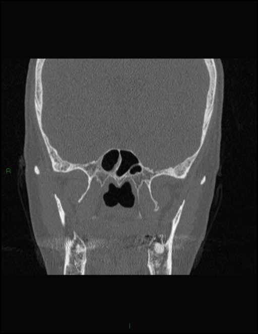 Bilateral frontal mucoceles (Radiopaedia 82352-96454 Coronal 228).jpg