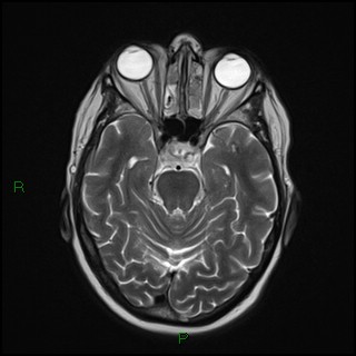 File:Bilateral frontal mucoceles (Radiopaedia 82352-96455 Axial T2 7).jpg
