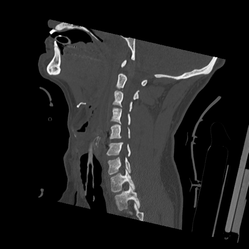 File:Bilateral locked facets (Radiopaedia 33850-35023 Sagittal bone window 37).png