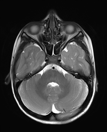 File:Bilateral mesial temporal polymicrogyria (Radiopaedia 76456-88181 Axial T2 6).jpg