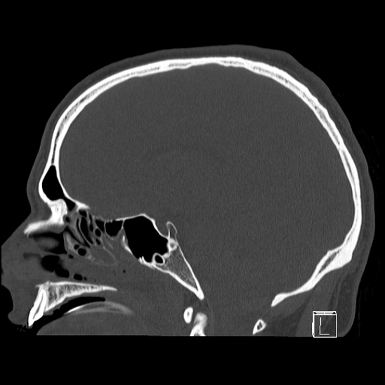 Bilateral occipital condyle fracture (type 2) (Radiopaedia 87675-104089 Sagittal bone window 59).jpg