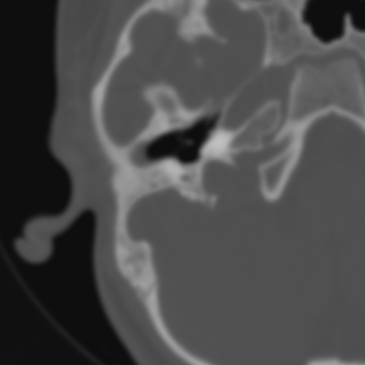 Bilateral otosclerosis (Radiopaedia 57237-64157 B 47).jpg