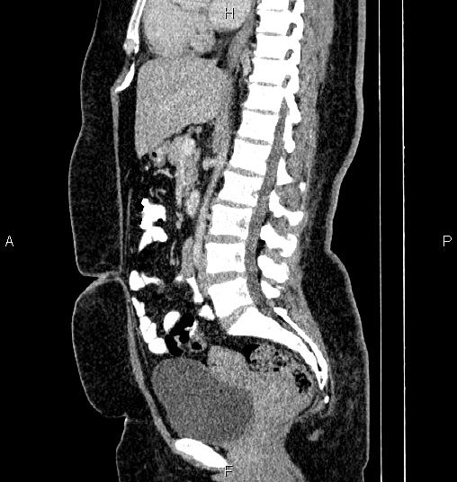 File:Bilateral ovarian dermoid cysts (Radiopaedia 85785-101603 D 45).jpg