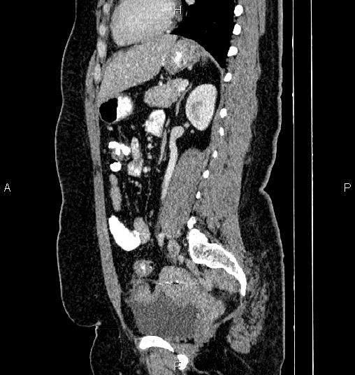 File:Bilateral ovarian dermoid cysts (Radiopaedia 85785-101603 D 58).jpg