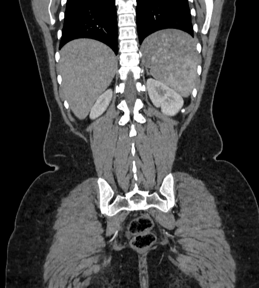 Bilateral ovarian mature cystic teratomas (Radiopaedia 79373-92457 B 81).jpg