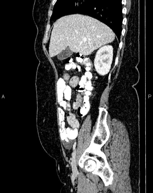 Bilateral ovarian serous cystadenocarcinoma (Radiopaedia 86062-101989 E 19).jpg