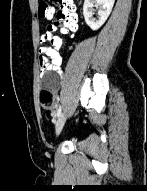 Bilateral ovarian teratoma (Radiopaedia 83131-97503 D 46).jpg