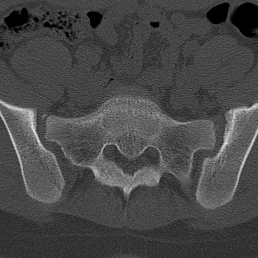 File:Bilateral pars defect (Radiopaedia 26691-26846 Axial bone window 83).jpg