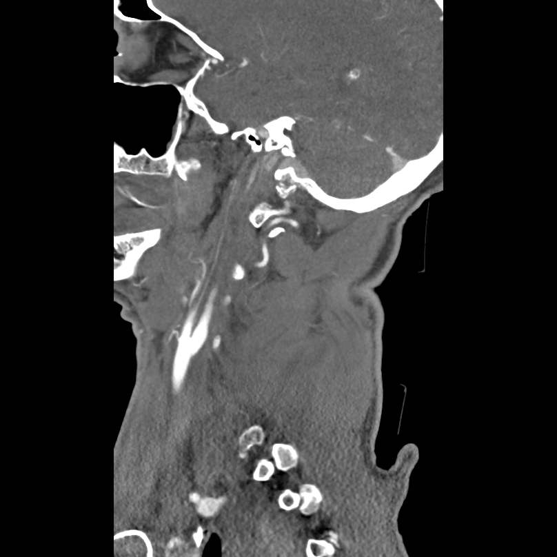 Bilateral perched facets with cord injury (Radiopaedia 45587-49713 B 9).jpg