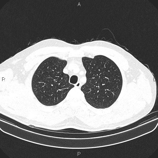File:Bilateral pulmonary AVM (Radiopaedia 83134-97505 Axial lung window 18).jpg